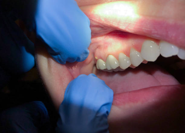 Best Emergency Dental Extractions in Alamo Heights, TX